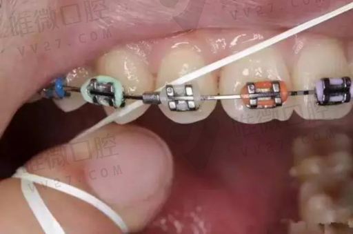 金属假牙与树脂假牙的区别,补牙是树脂还是烤瓷牙好(图1)